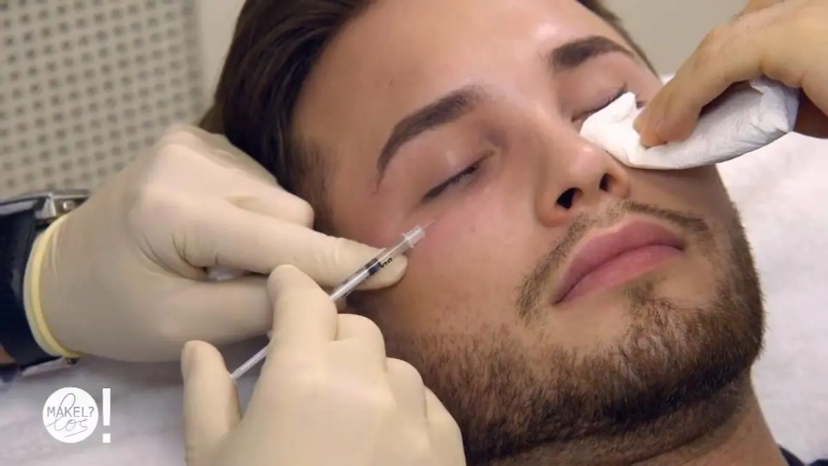 Maxim bekommt eine minimale Verbesserung Mesobotox gegen die Falten