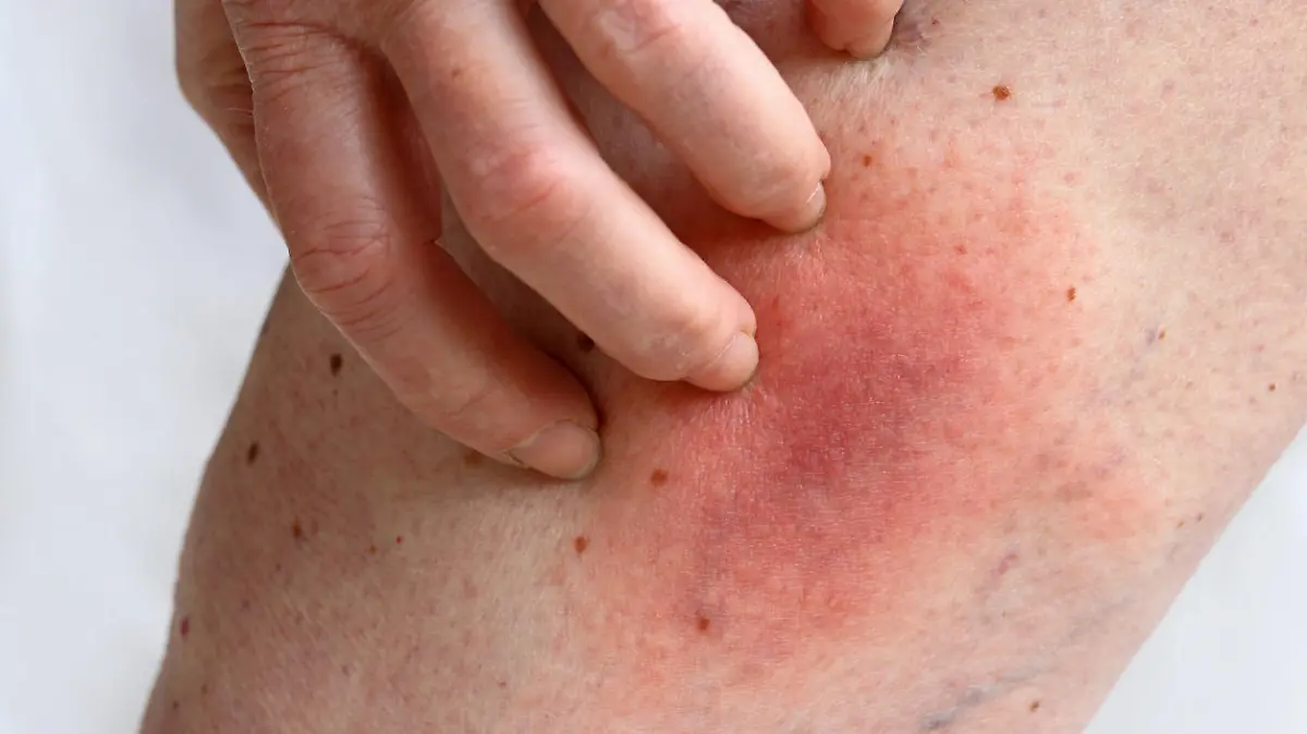 Allergic reaction to a bee sting on a woman's leg. Allergic rash