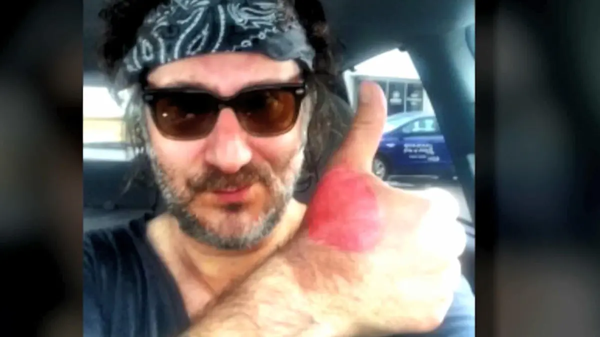 'Margarita-Dermitis': Adam Levy trug Brandblasen davon Verbrennung durch Limettensaft
