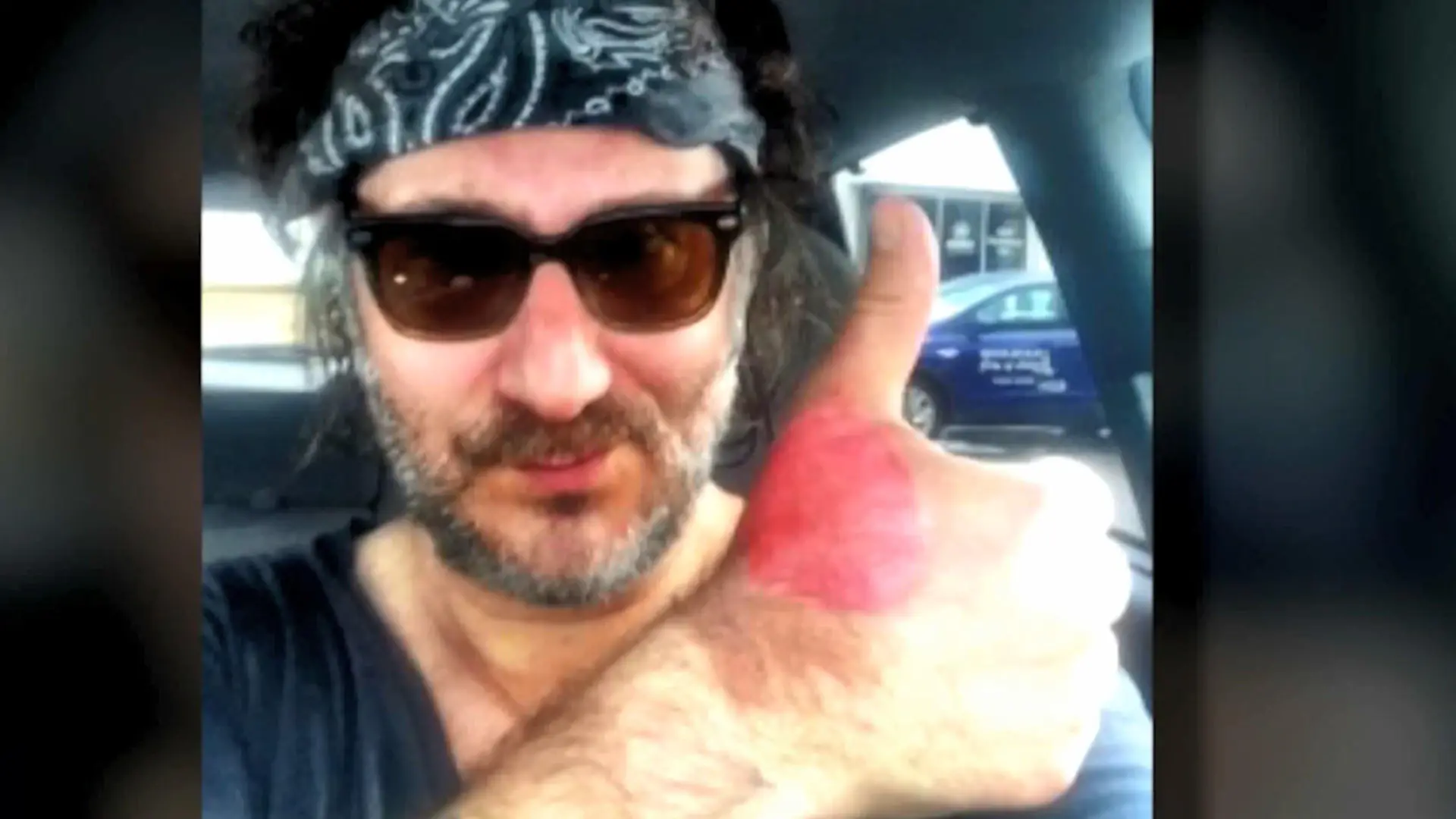 'Margarita-Dermitis': Adam Levy trug Brandblasen davon Verbrennung durch Limettensaft