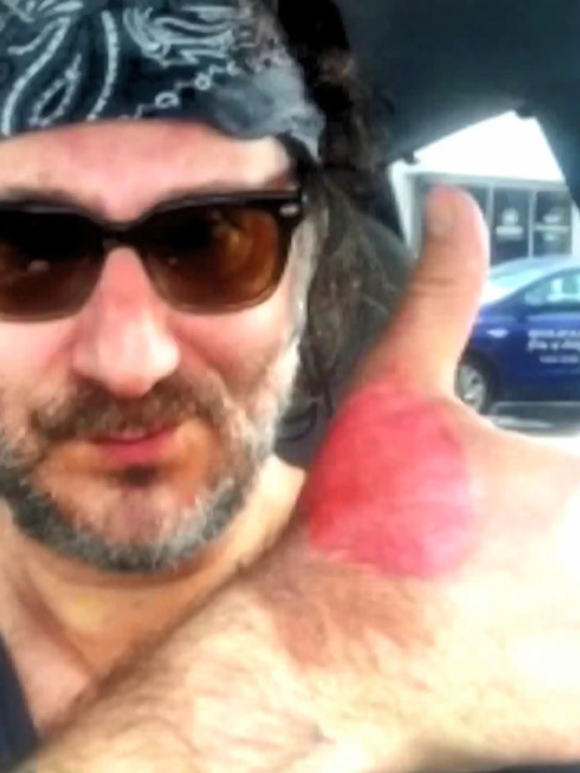 Bild zu: "'Margarita-Dermitis': Adam Levy trug Brandblasen davon"