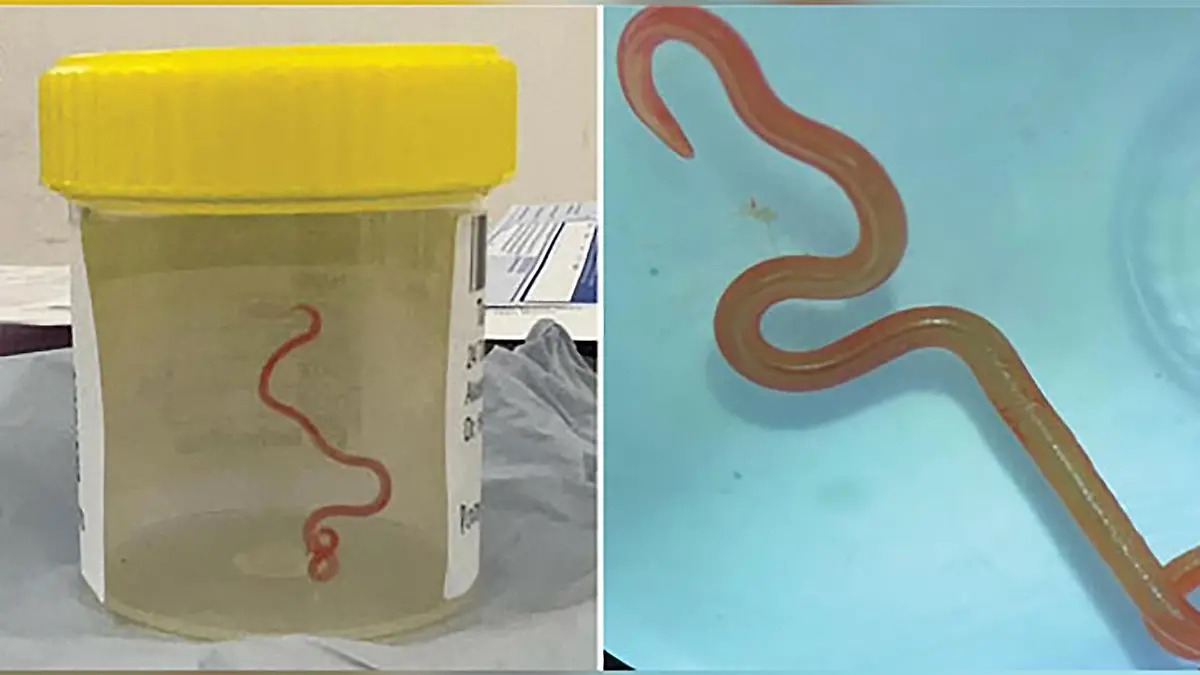 HANDOUT - 28.08.2023, Australien, Canberra: Das undatiertes Bild zeigt einen lebenden Spulwurm "Ophidascaris robertsi", der im Gehirn einer 64-jährigen Australierin gefunden wurde. In einem Krankenhaus in Canberra haben Ärzte einen lebendigen, acht Zentimeter langen Rundwurm aus dem Gehirn einer 64-jährigen Frau entfernt. Bei dem Parasiten handele es sich um die Spezies Ophidascaris robertsi, die normalerweise nur in Pythons vorkomme. Foto: Emerging Infectious Diseases/AAP/dpa - ACHTUNG: Nur zur redaktionellen Verwendung und nur mit vollständiger Nennung des vorstehenden Credits +++ dpa-Bildfunk +++