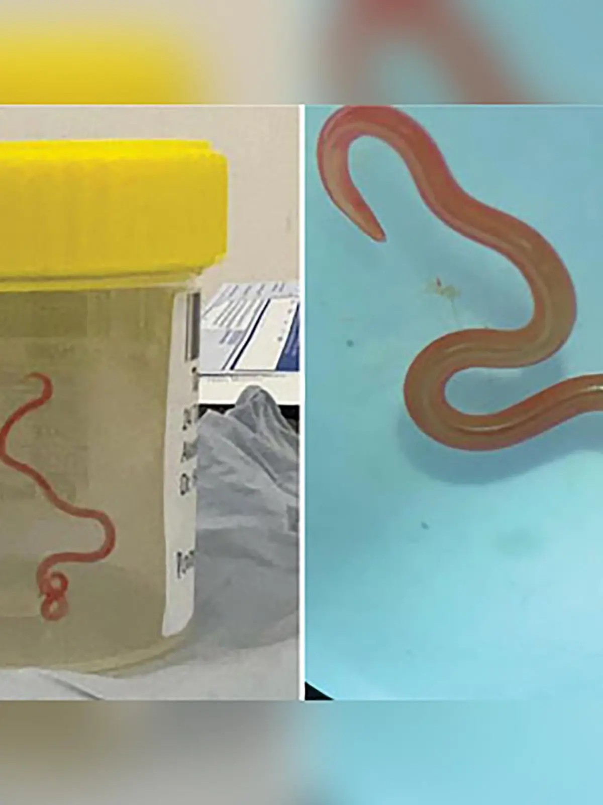 HANDOUT - 28.08.2023, Australien, Canberra: Das undatiertes Bild zeigt einen lebenden Spulwurm "Ophidascaris robertsi", der im Gehirn einer 64-jährigen Australierin gefunden wurde. In einem Krankenhaus in Canberra haben Ärzte einen lebendigen, acht Zentimeter langen Rundwurm aus dem Gehirn einer 64-jährigen Frau entfernt. Bei dem Parasiten handele es sich um die Spezies Ophidascaris robertsi, die normalerweise nur in Pythons vorkomme. Foto: Emerging Infectious Diseases/AAP/dpa - ACHTUNG: Nur zur redaktionellen Verwendung und nur mit vollständiger Nennung des vorstehenden Credits +++ dpa-Bildfunk +++