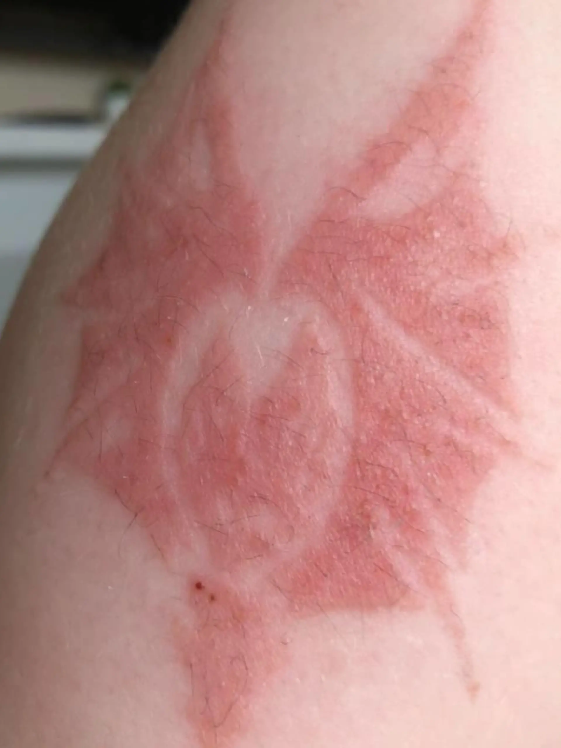 Cadens Arm mit Hautentzündung in Form eines Drachens