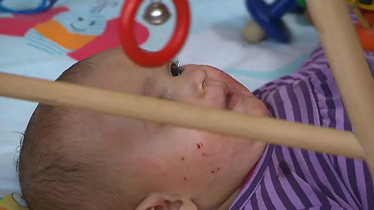 Neurodermitis bei Babys Krankheit wird vererbt