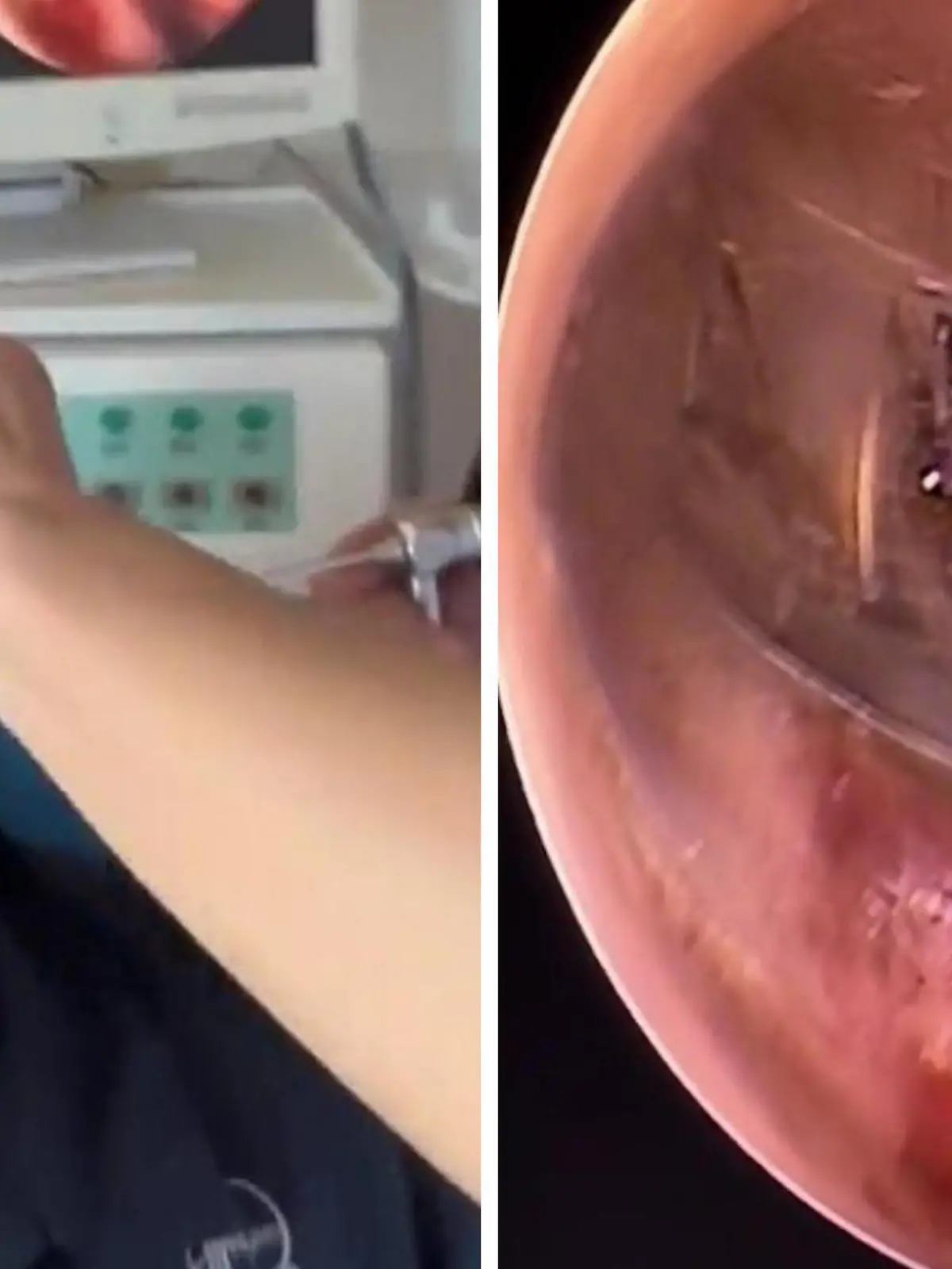Achtung – Spinnenphobiker sollten hier wegsehen! Ein Chinese ist wegen Ohrenschmerzen zum Arzt gegangen – dort bekam er die Schock-Diagnose: Eine Spinne hat es sich in seinem Gehörgang bequem gemacht.