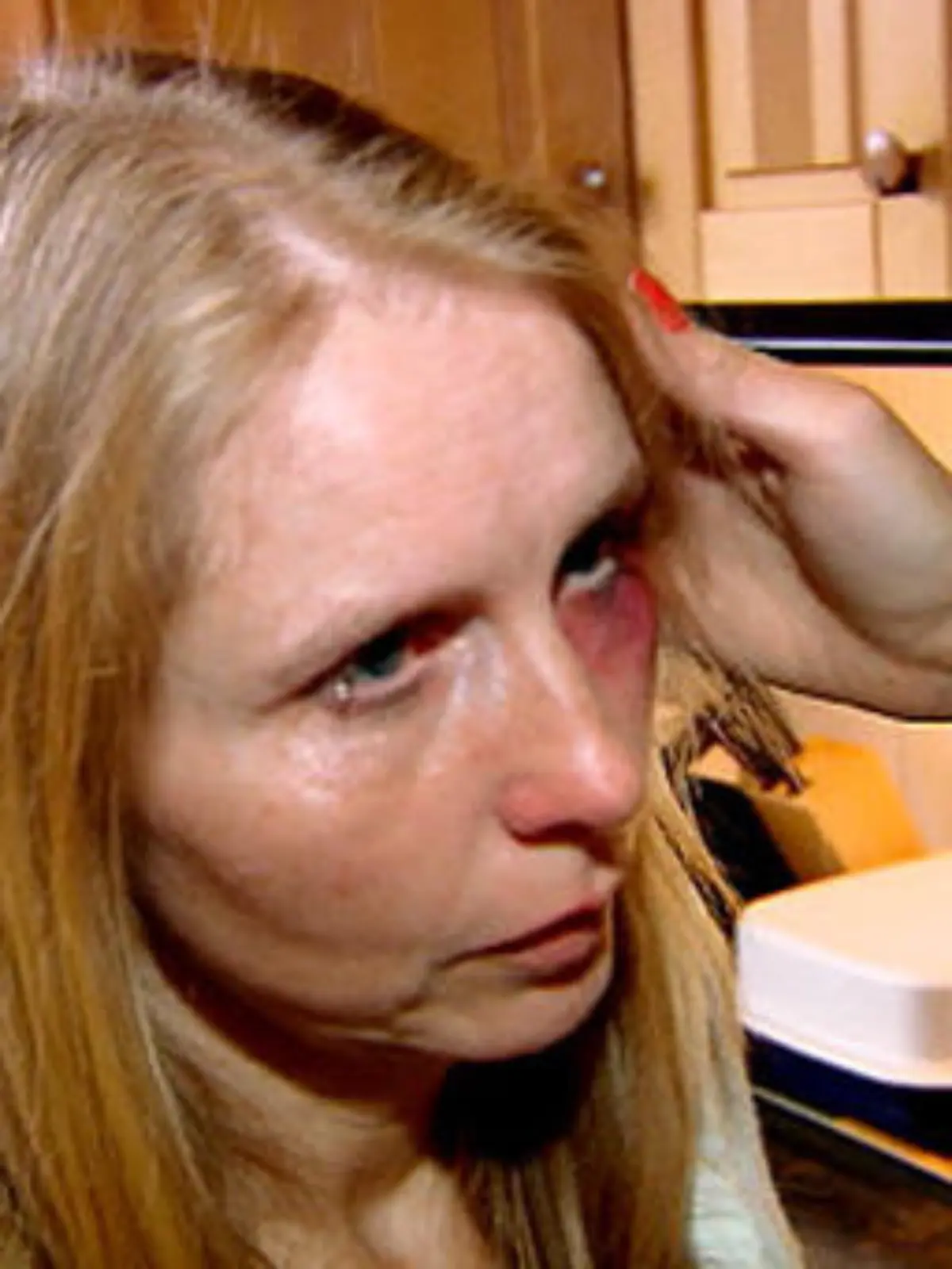 Bild zu: "Mutter hat ein blaues Auge"