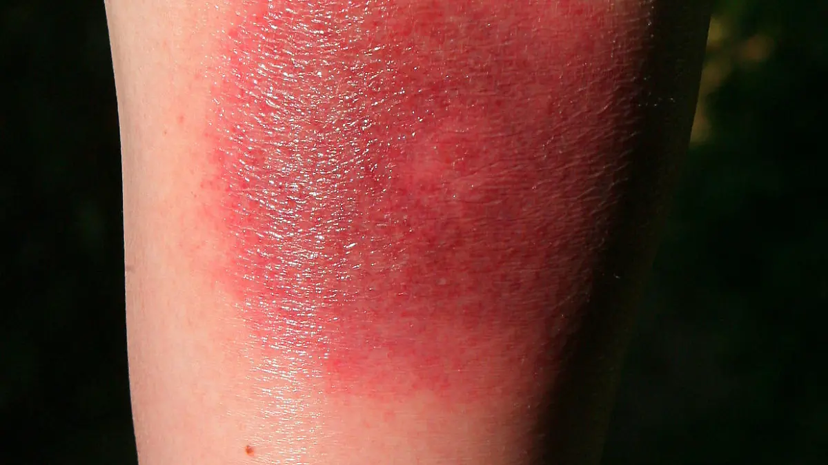 Eine Wade nach einem Zeckenstich, aufgenommen am 18.07.2006 in Stuttgart. Eines der wenigen charakteristischen Symptome einer Borreliose ist das so genannte Erythema migrans, auch Wanderröte genannt. Diese ringförmige Hautrötung kann einige Tage bis Wochen nach einem Zeckenstich auftreten. Foto: Harry Melchert dpa/lsw +++(c) dpa - Report+++