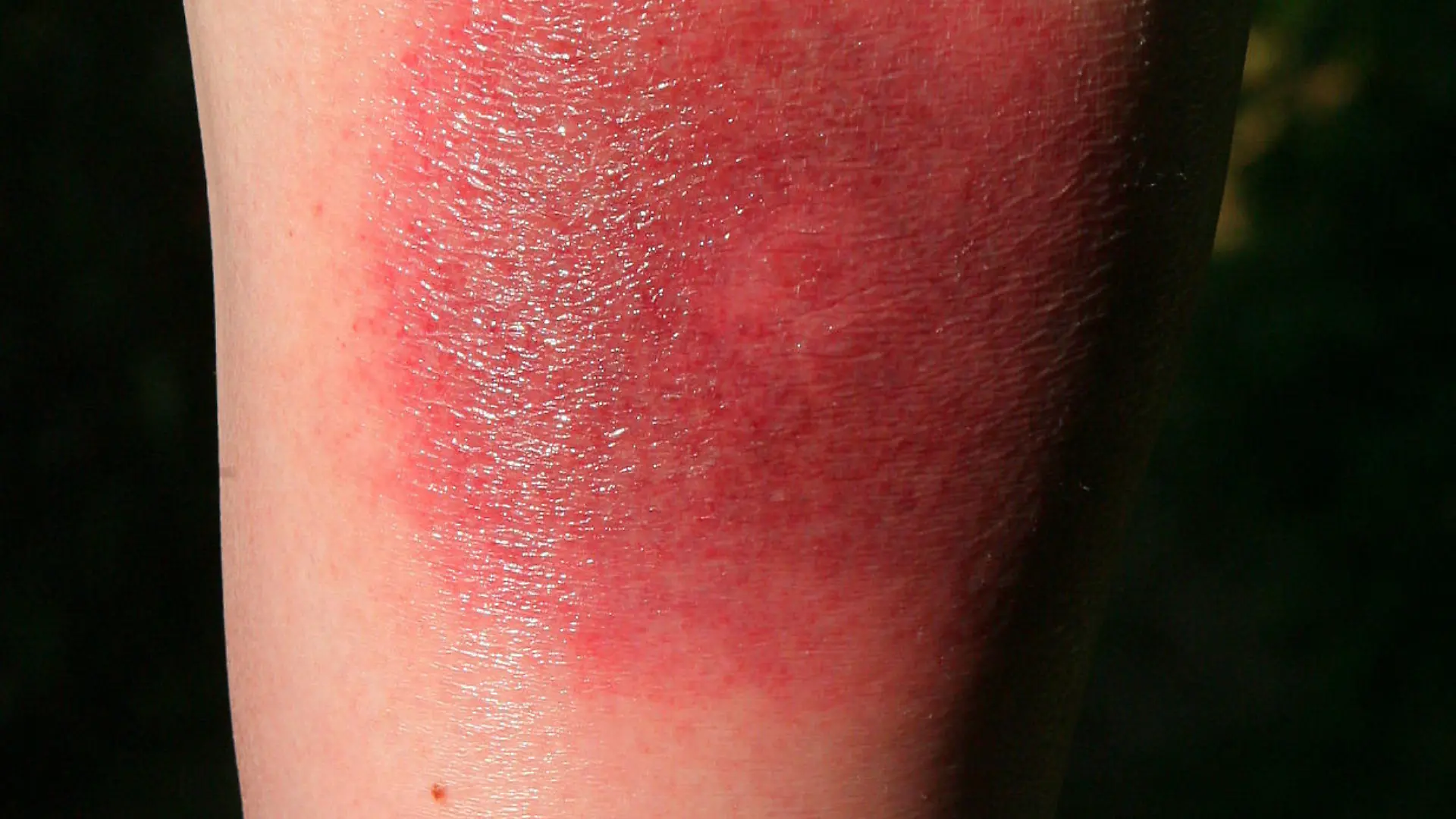Eine Wade nach einem Zeckenstich, aufgenommen am 18.07.2006 in Stuttgart. Eines der wenigen charakteristischen Symptome einer Borreliose ist das so genannte Erythema migrans, auch Wanderröte genannt. Diese ringförmige Hautrötung kann einige Tage bis Wochen nach einem Zeckenstich auftreten. Foto: Harry Melchert dpa/lsw +++(c) dpa - Report+++