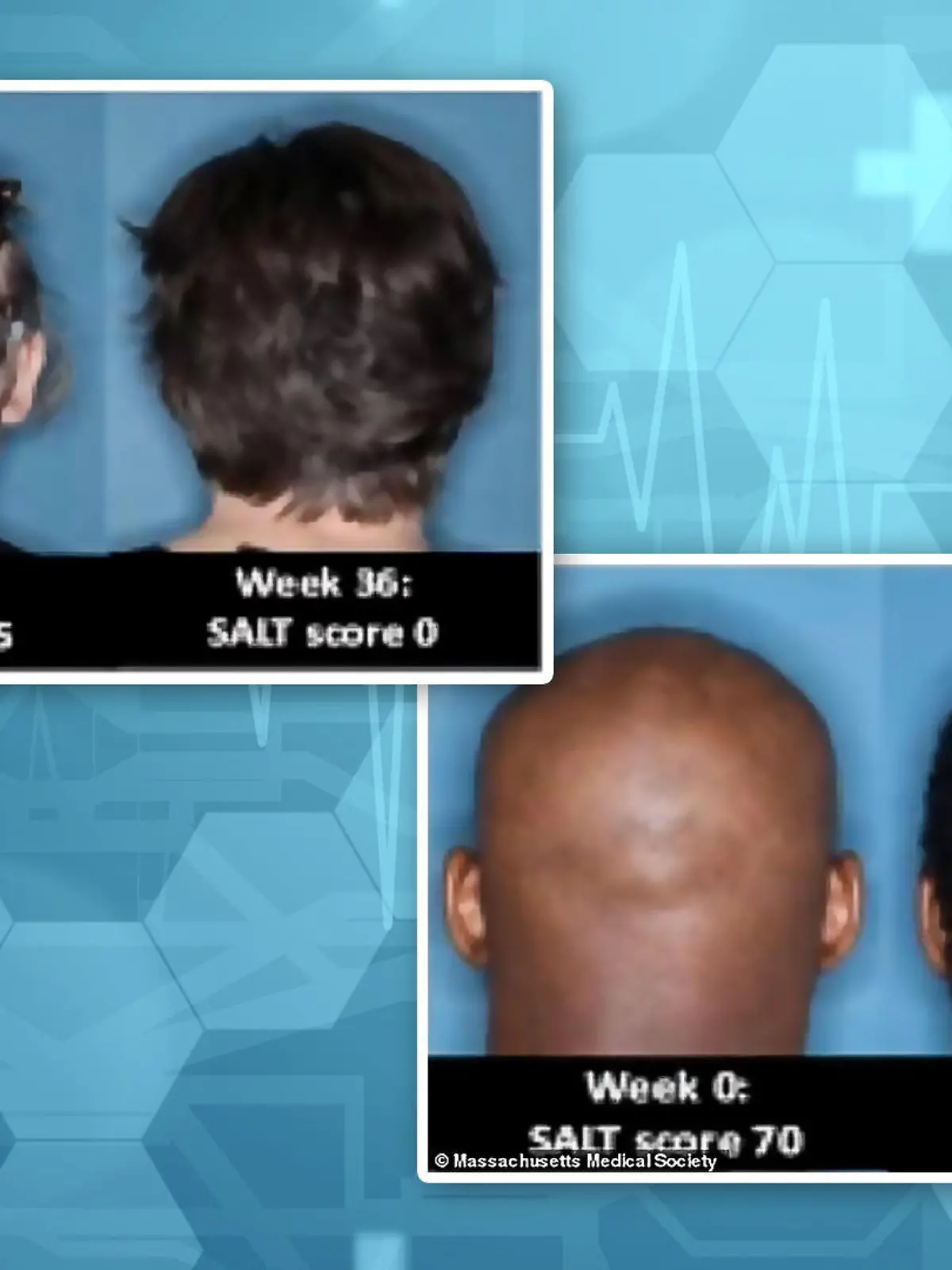 Betroffene mit kreisrundem Haarausfall, die im Rahmen einer neuen Studie ein neues Medikament getestet haben.