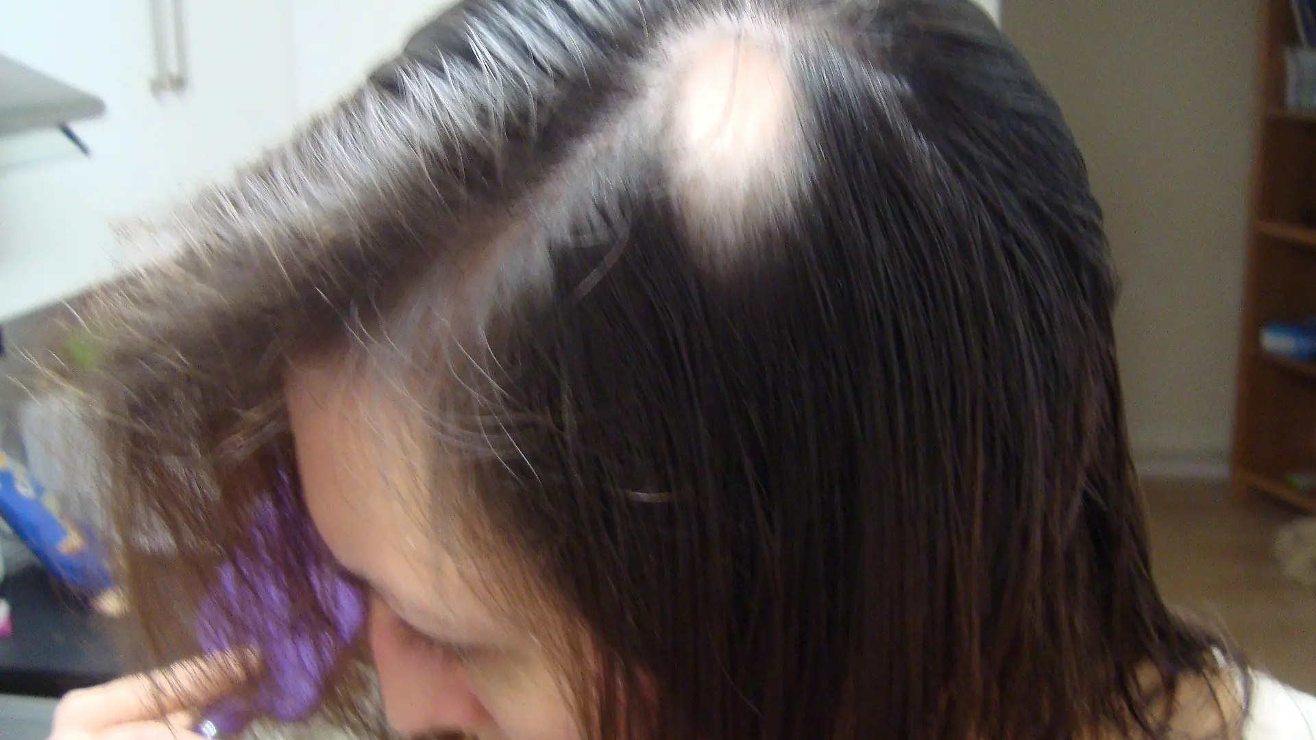 Schlimm! Weil sie die Hochzeitsvorbereitungen so stressten, fielen Ellie die Haare aus!. - Collect picture. Ellie Baker during her hairloss. Plymouth, England. October 2012. A bride-to-be has revealed she suffered so much stress planning her wedding she went BALD just before her big day. See SWNS story SWHAIR; Hairdresser Ellie Baker, 35, was devastated when she lost her own locks and had to walk down the aisle in specially designed extensions after suffering alopecia. She had been busy planning the ceremony when the stress of organising the event contributed to her hair beginning to fall out. Ellie said she was terrified of being a bald bride and "freaked out" when she discovered great clumps of her hair starting to fall out when she got out the shower.