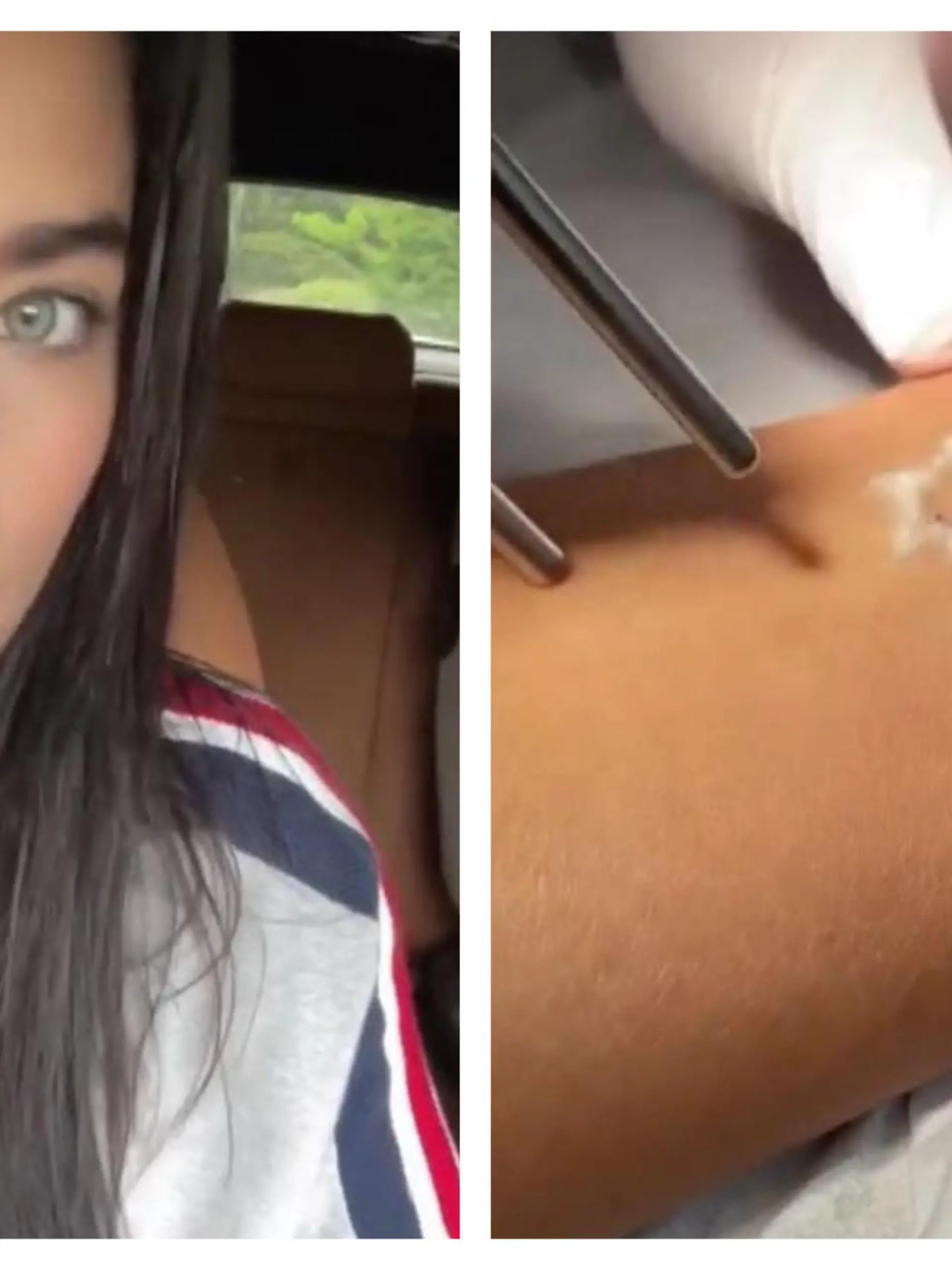 Amira Pocher lässt sich ihre Tattoos weglasern.