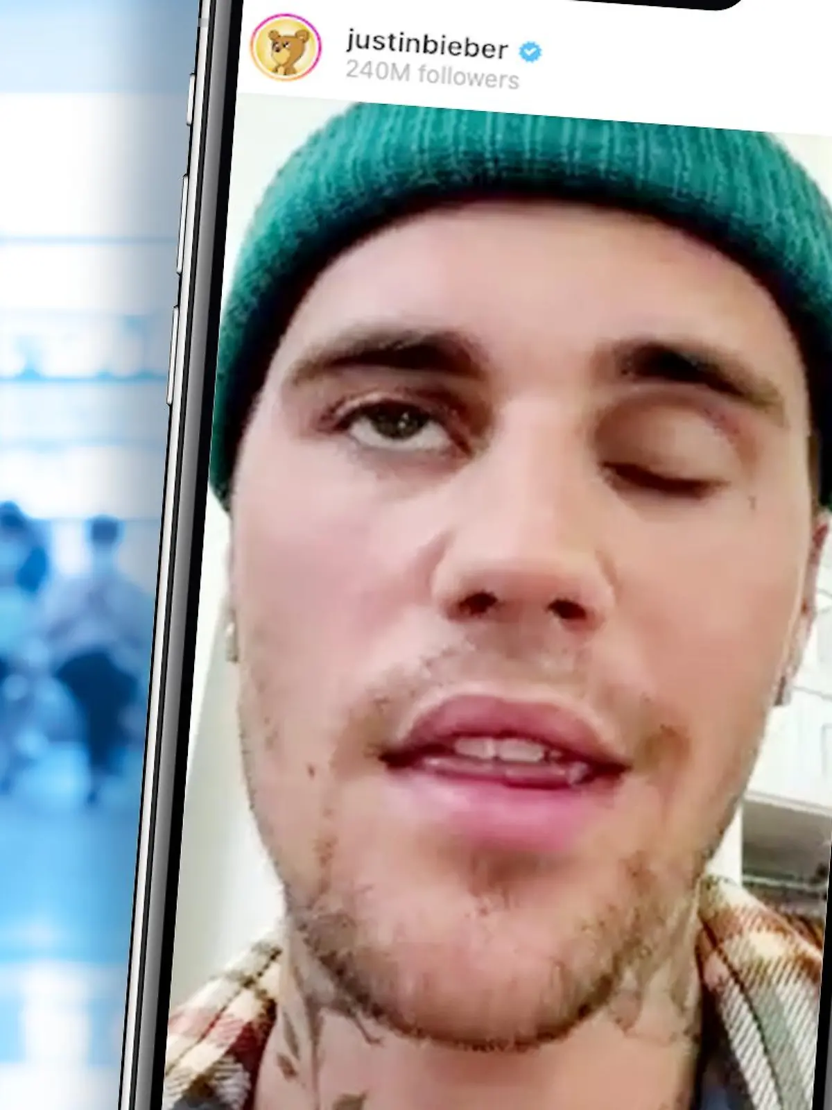 Justin Bieber hat wegen des Ramsay-Hunt-Syndroms eine halbseitige Gesichtslähmung.
