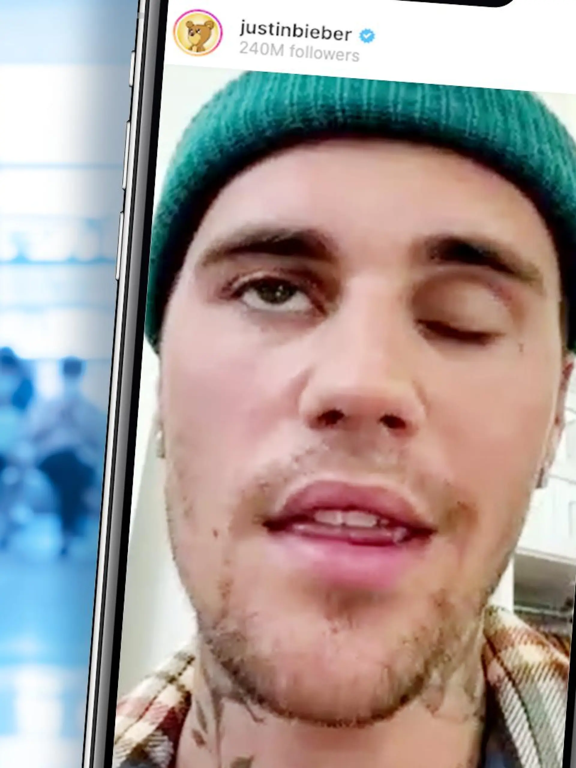 Justin Bieber hat wegen des Ramsay-Hunt-Syndroms eine halbseitige Gesichtslähmung.