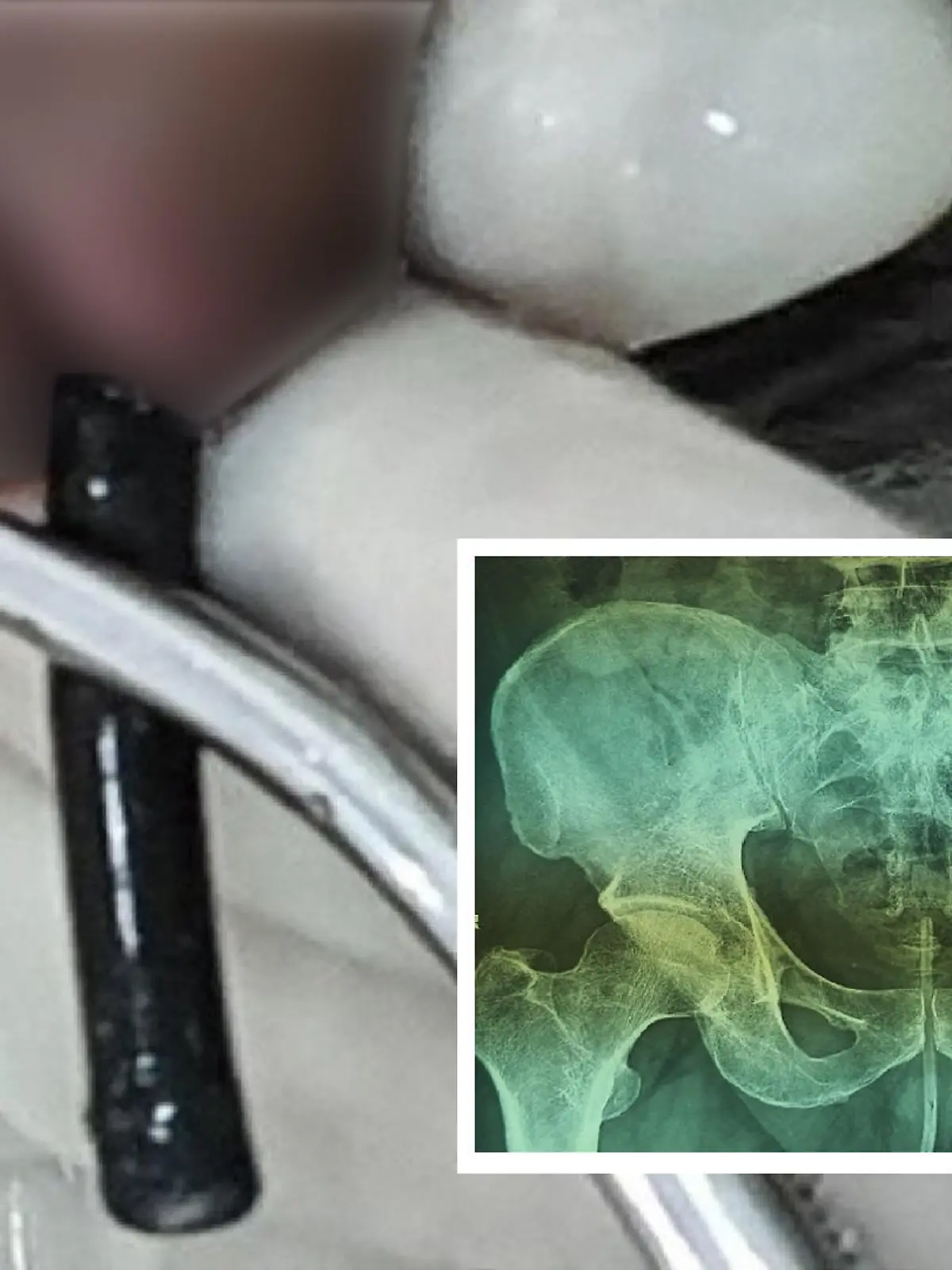 Ärzte ziehen Mann 18-Zentimeter-Kabel aus Penis.