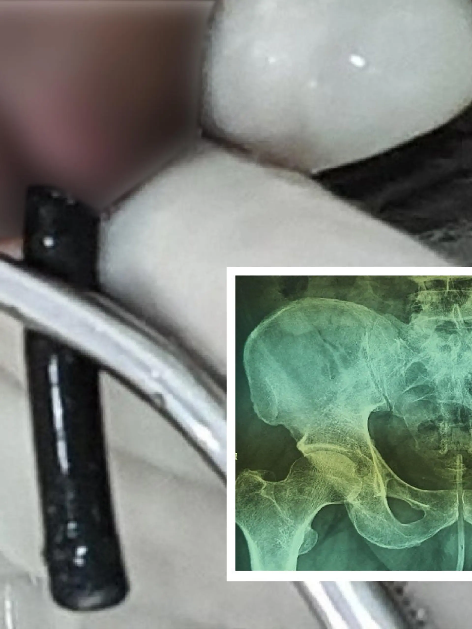 Ärzte ziehen Mann 18-Zentimeter-Kabel aus Penis.