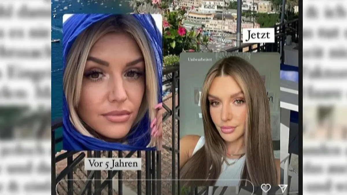 Botox: Gerda Lewis wagt den Vorher-Nachher-Vergleich.