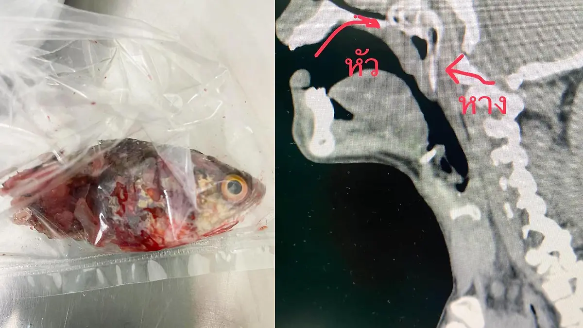 Thailand: Fischer muss notoperiert werden, weil ihm ein Fisch in den Rachen springt