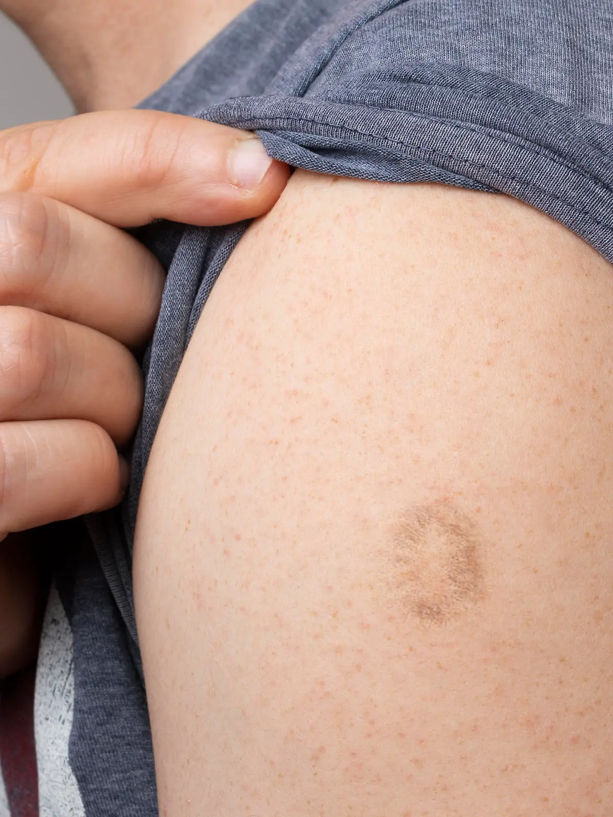 Monkeypox and smallpox vaccine scar on young man's arm