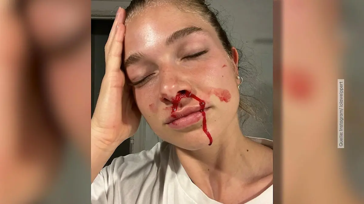 Lola Weippert hat heftiges Nasenbluten "Keine Gehirnblutung"