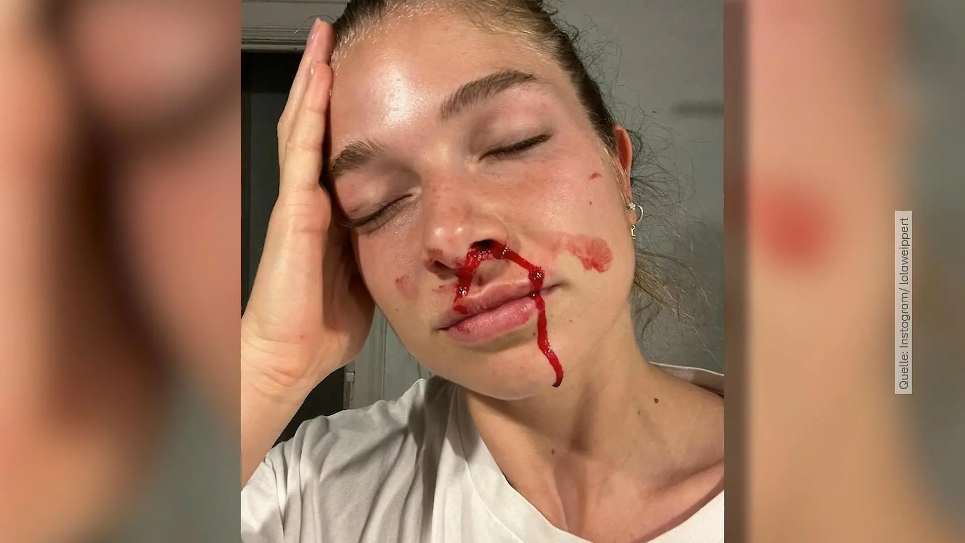 Lola Weippert hat heftiges Nasenbluten "Keine Gehirnblutung"