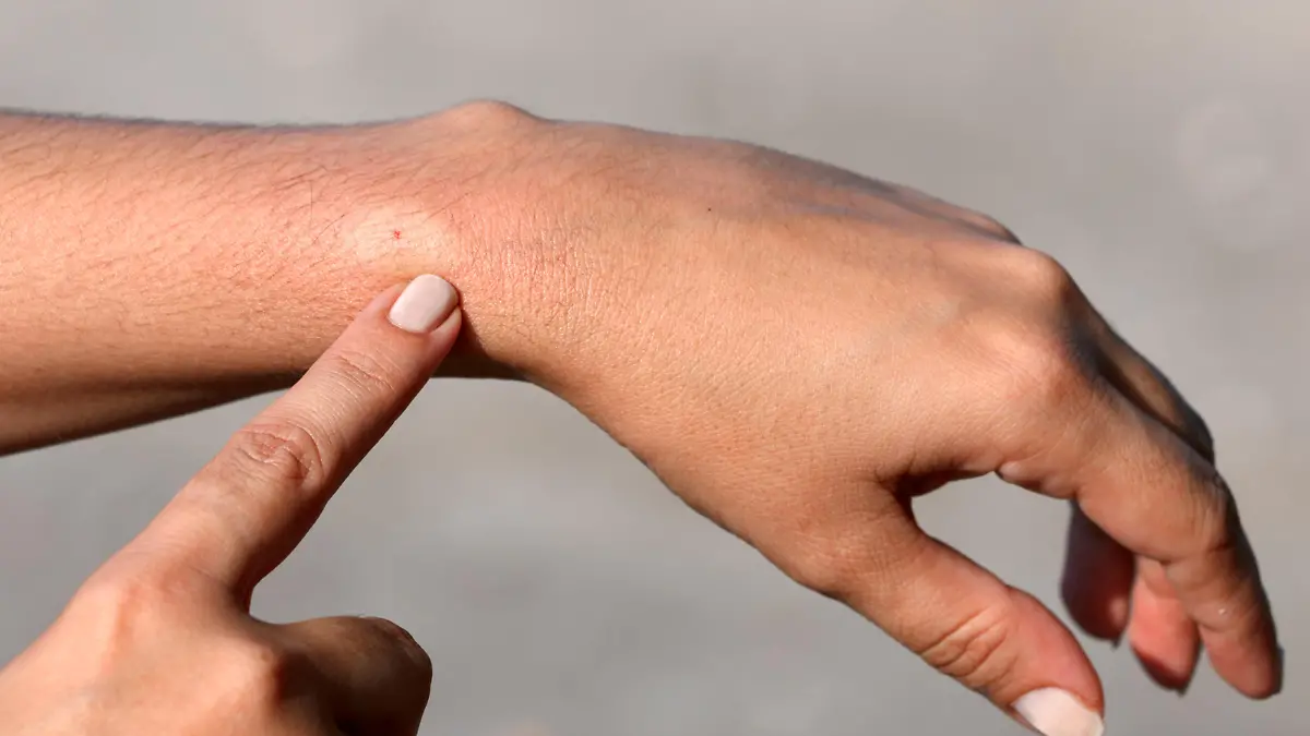 Bee sting