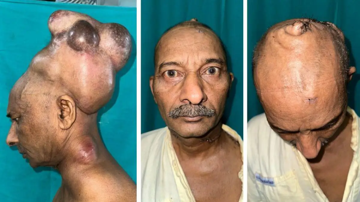 Ravindra Bishu vor und nach der Operation