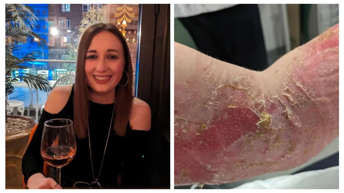 Jade McKenna/Arm Verbrennung