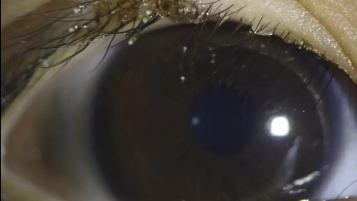 Rund um den Wimpernkranz des Jungen tummeln sich winzige Läuse.