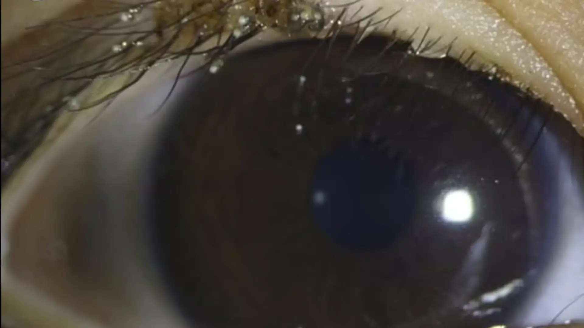 Rund um den Wimpernkranz des Jungen tummeln sich winzige Läuse.