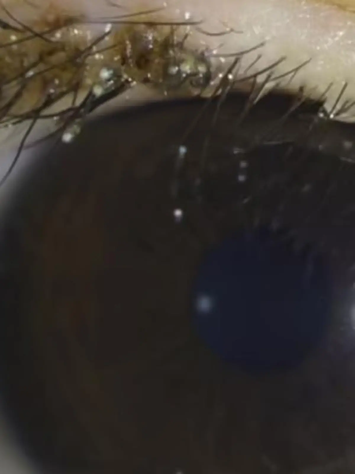 Rund um den Wimpernkranz des Jungen tummeln sich winzige Läuse.