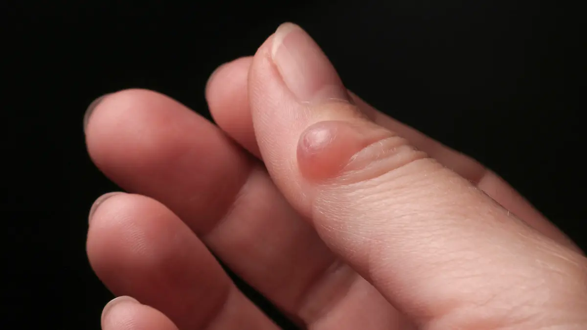 Hygroma (Ganglion cyst) of the thumb joint. Selective focus.