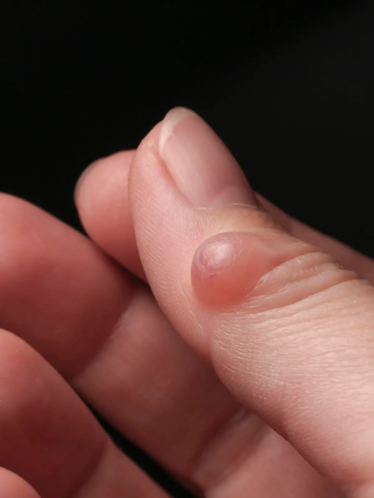 Hygroma (Ganglion cyst) of the thumb joint. Selective focus.