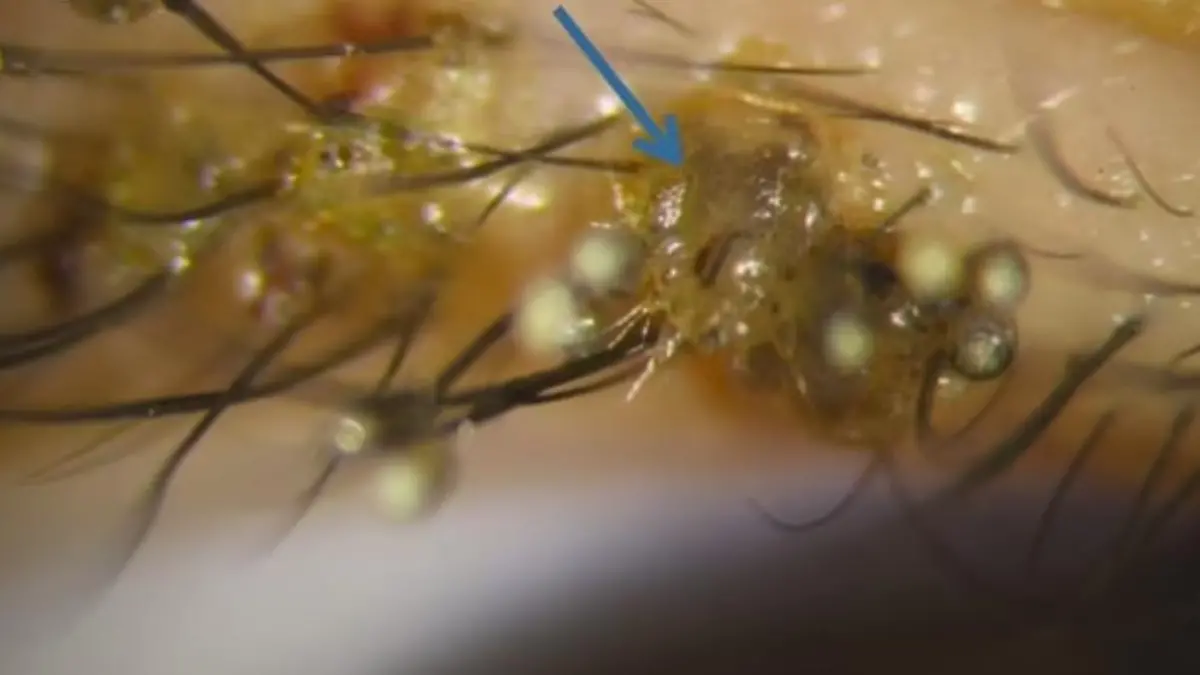 Über und über sind die Wimpern mit Nissen bedeckt.