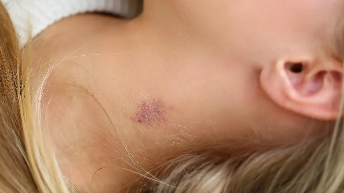 Close-up of womans neck with small bruise. Blue and red colour mark on female skin. Hickey or love bite. Domestic violence or simple body injury concept