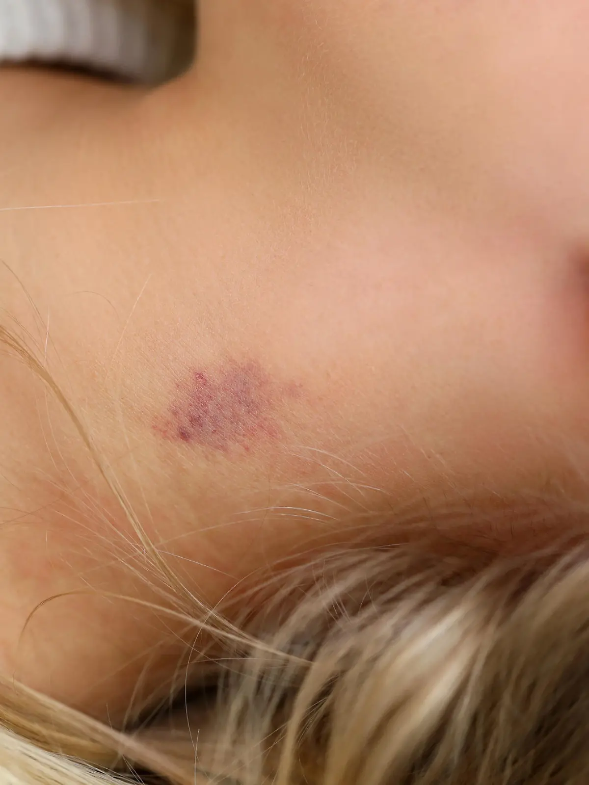 Close-up of womans neck with small bruise. Blue and red colour mark on female skin. Hickey or love bite. Domestic violence or simple body injury concept