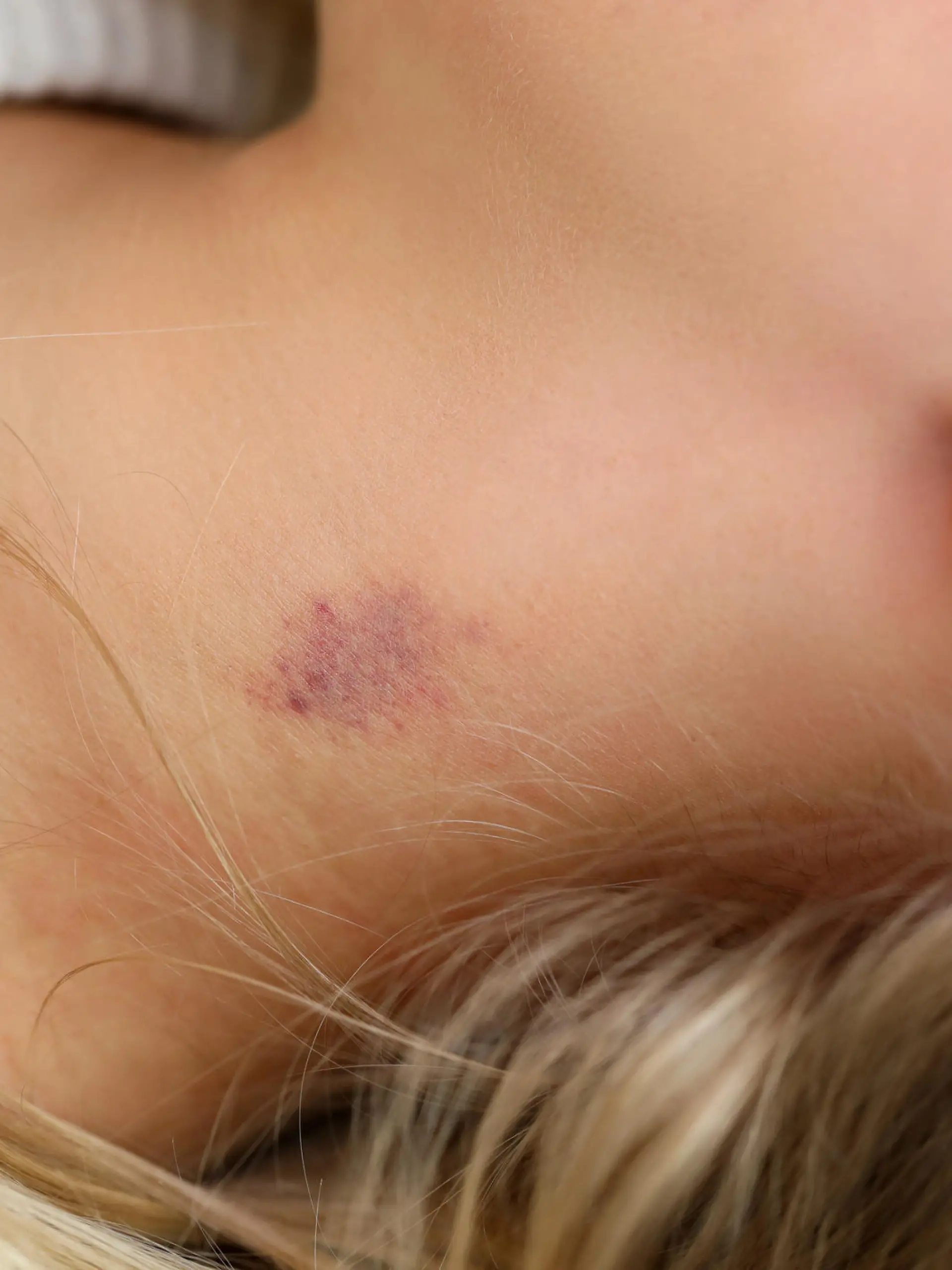 Close-up of womans neck with small bruise. Blue and red colour mark on female skin. Hickey or love bite. Domestic violence or simple body injury concept