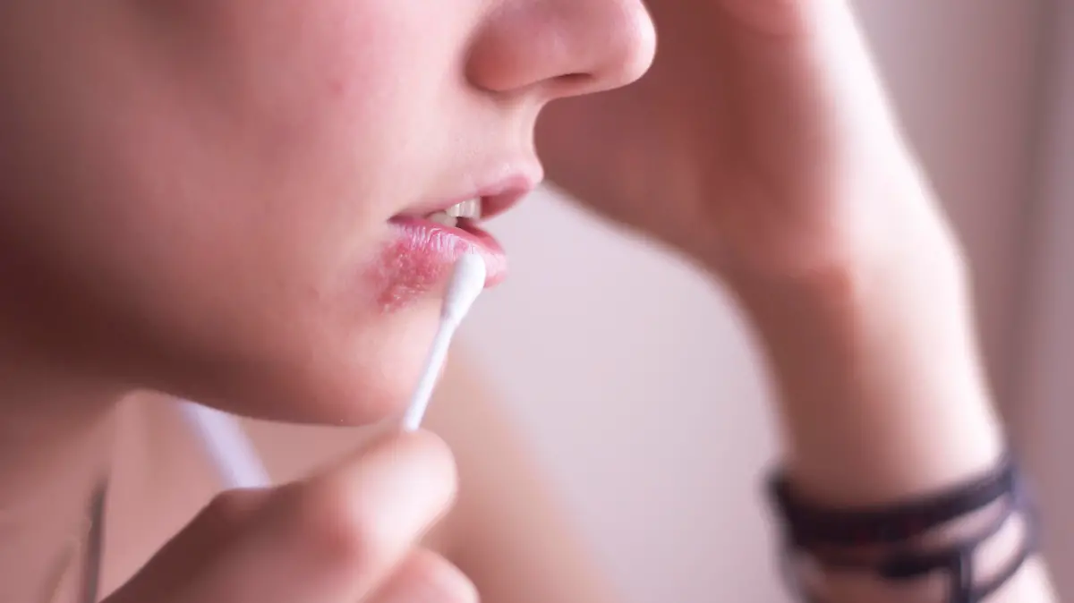 Female face with herpes on the lips
