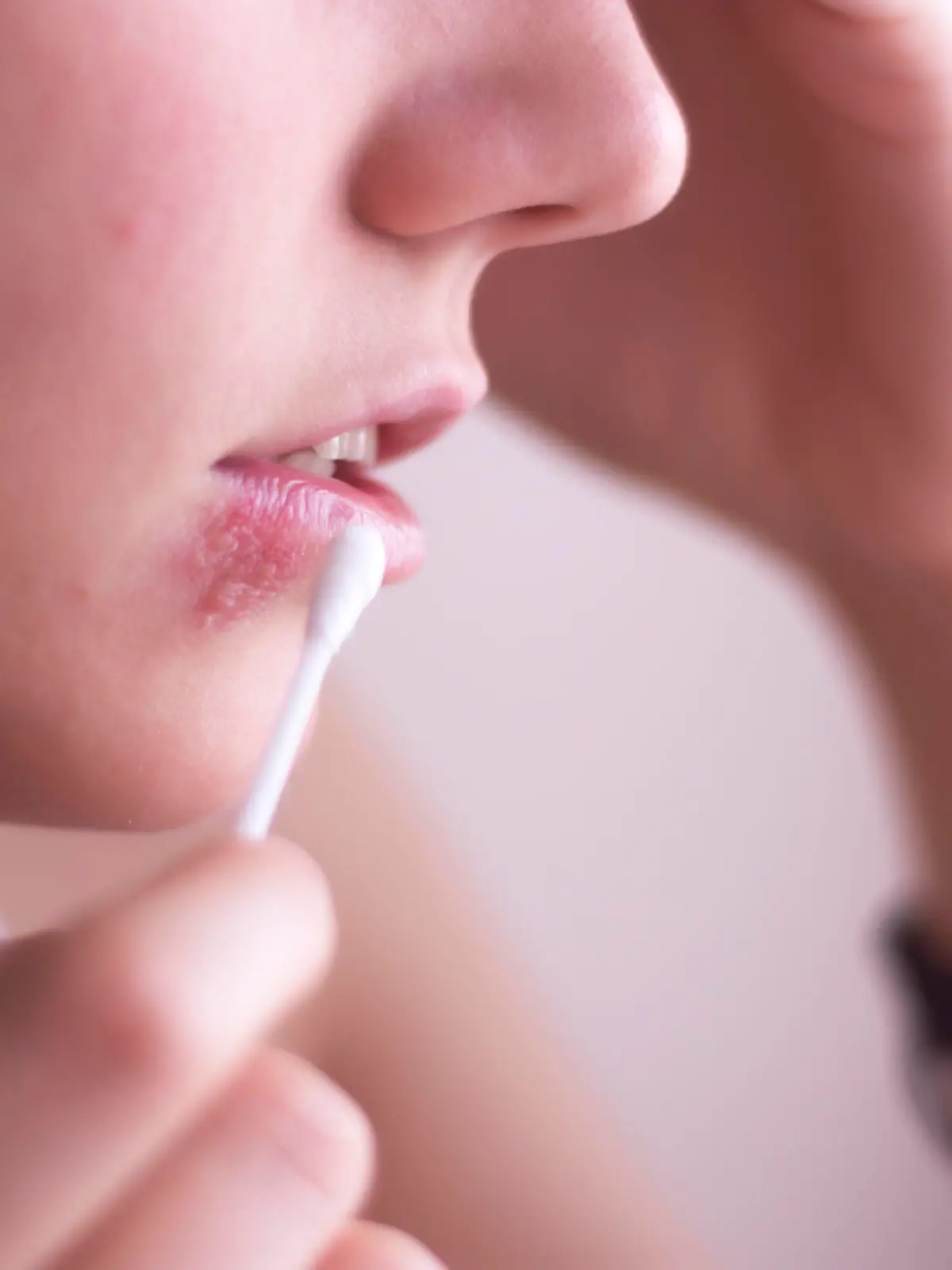 Female face with herpes on the lips