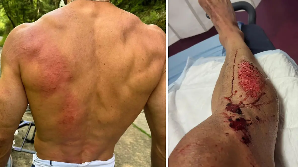 Biathlon-Star Simon Fourcade erleidet schwere Verletzungen bei Horror-Sturz.
