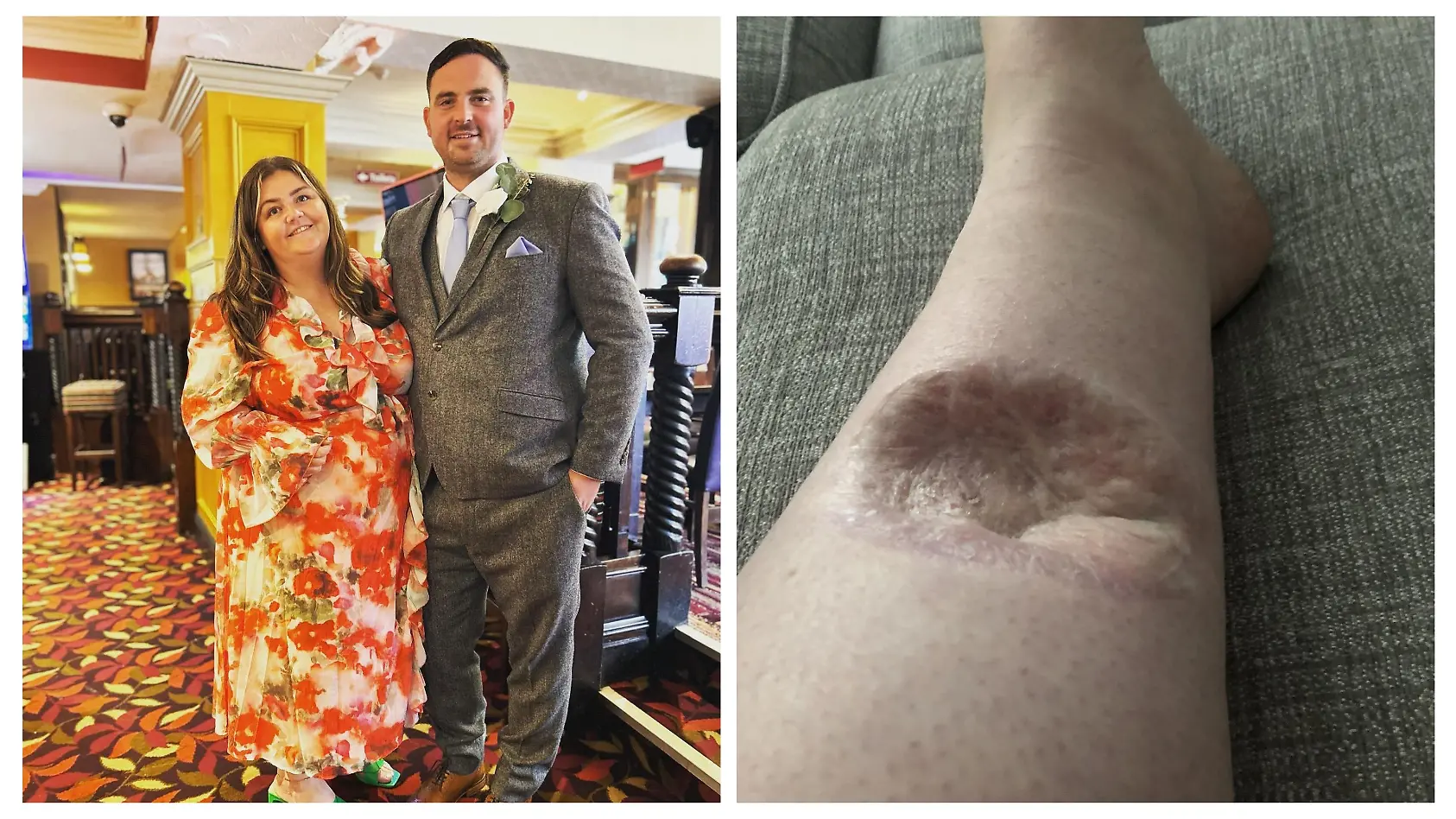 Tumor hinterlässt Loch in Megans Bein