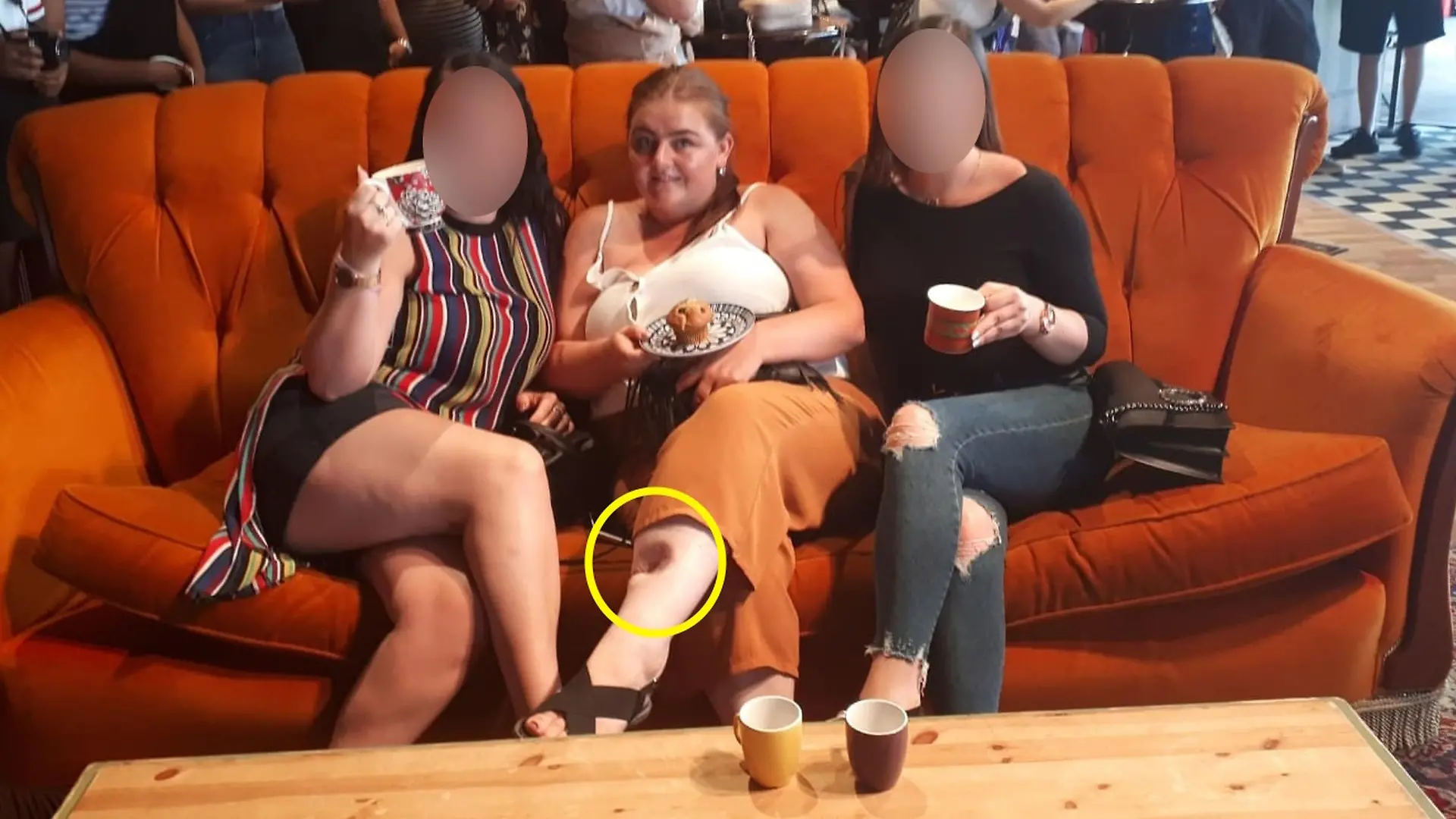 PIX FROM Kennedy News & Media (Pictured:MEGAN GRIEVES, 36, HAS BEEN LEFT WITH A 'CRATER' IN HER LEG AFTER BEING DIAGNOSED WITH MELANOMA SKIN CANCER IN 2016 AND HAVING HER MOLE REMOVED.) A mum has been left with a giant 'CRATER' in her leg after she claims doctors dismissed her cancer as 'flaky skin' for a decade - but her DEAD GRAN knew best and 'saved her life'. Megan Grieves, from Leicester in Leicestershire, says she attended more than 30 GP appointments during a 10-year period after her late grandma June Evans, 69, raised concerns about a small mole on her left leg. The now 36-year-old claims her growing mole was passed off as dry skin at every check-up and was prescribed moisturising creams to treat the flaky patch on her shin. DISCLAIMER: While Kennedy News and Media uses its best endeavours to establish the copyright and authenticity of all pictures supplied, it accepts no liability for any damage, loss or legal action caused by the use of images supplied and the publication of images is solely at your discretion. SEE KENNEDY NEWS COPY - 0161 697 4266