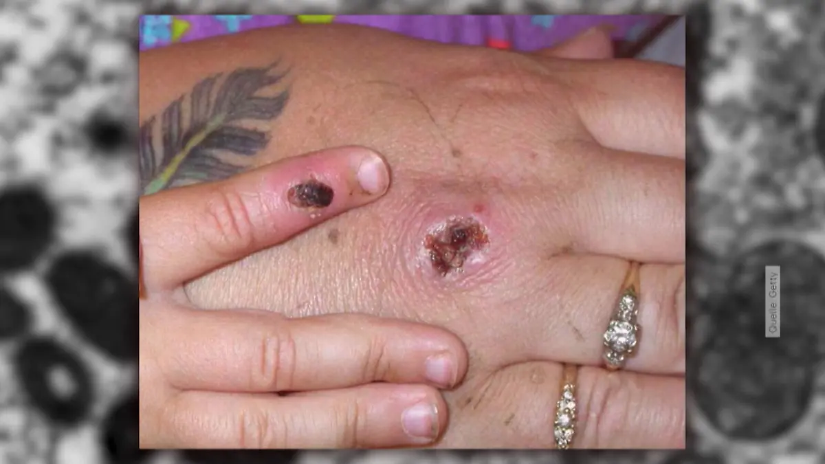 Erster Fall von Affenpocken in Deutschland nachgewiesen