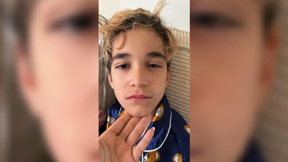 Noah nach Begegnung mit Eichenprozessionsspinner.