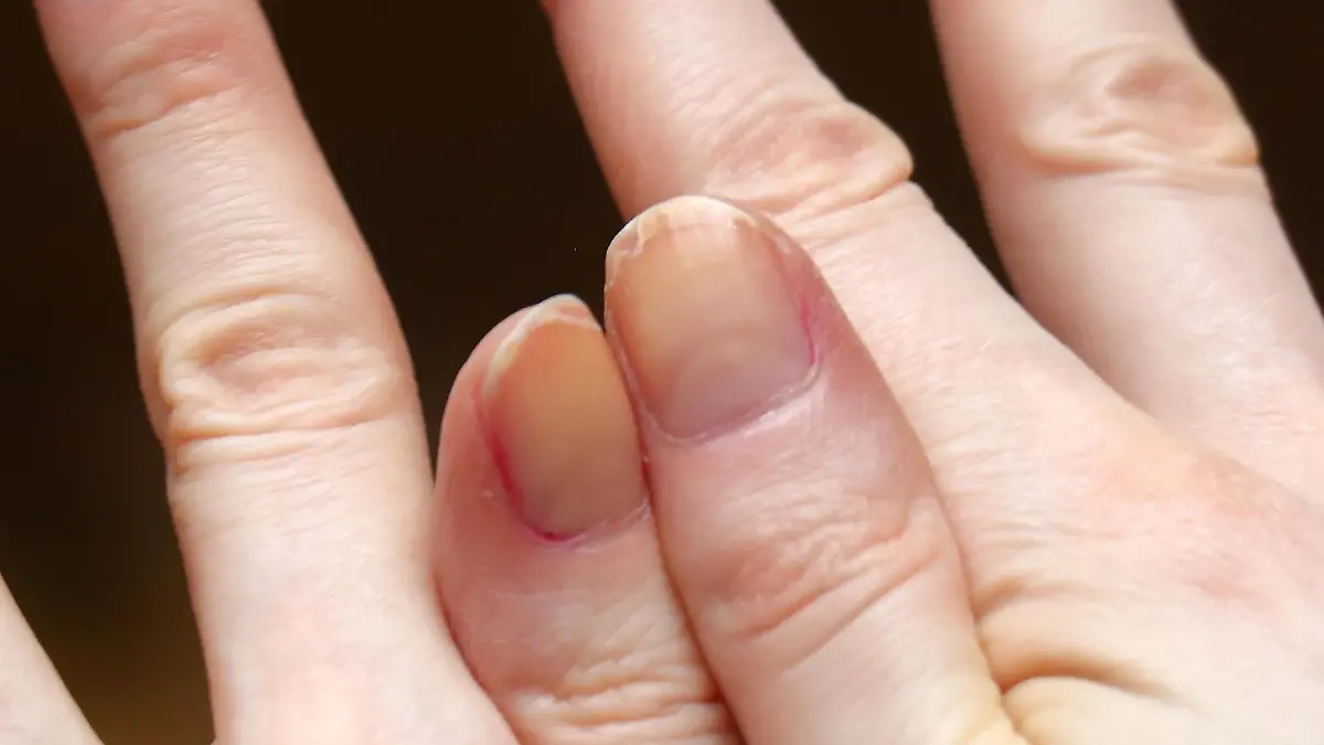 Cracked fingernails with brittle splitting and peeling nails