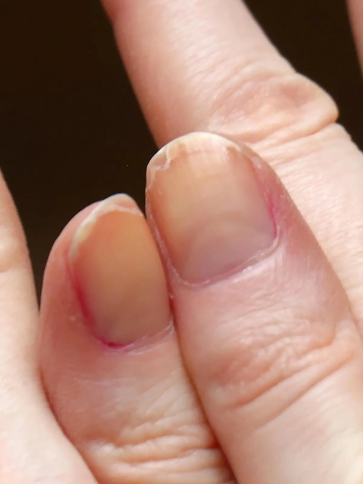 Cracked fingernails with brittle splitting and peeling nails