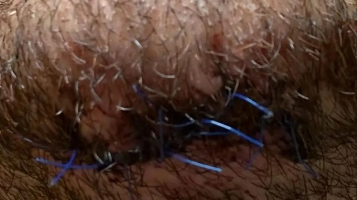 Lukas Tulovic musste auch am Kinn genäht werden