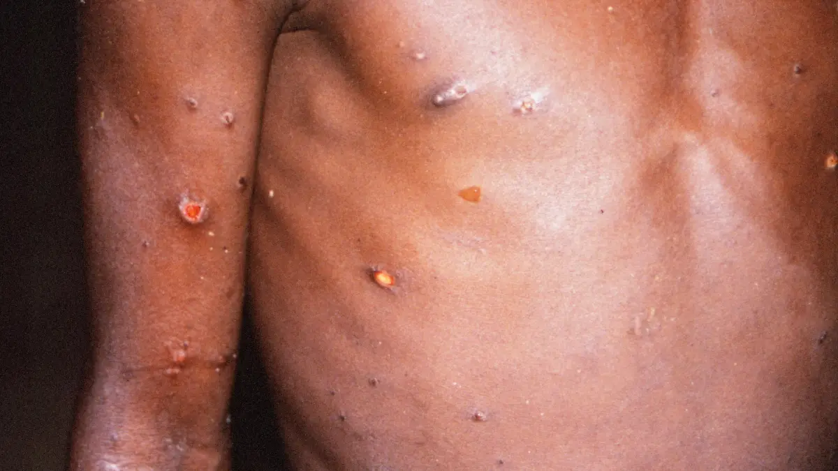 Monkeypox Patient