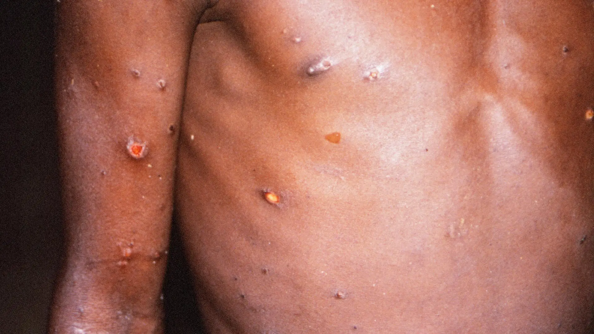 Monkeypox Patient