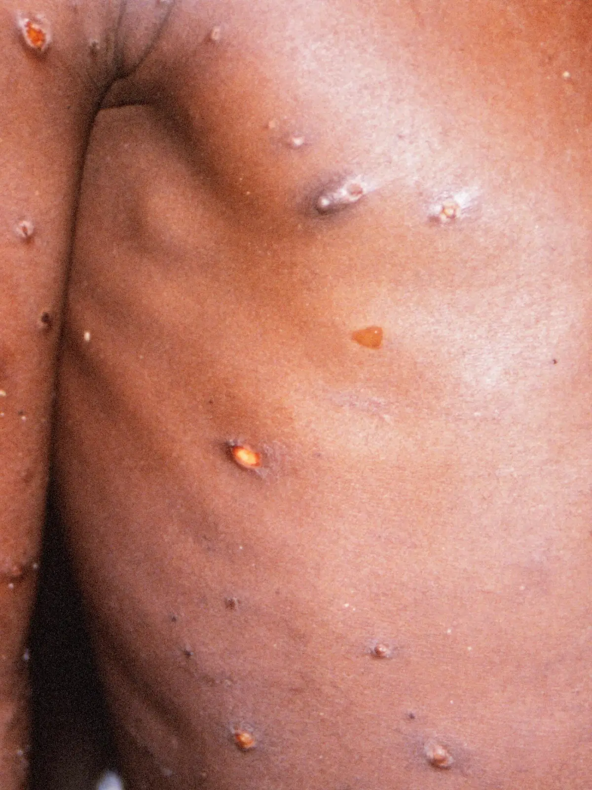 Monkeypox Patient